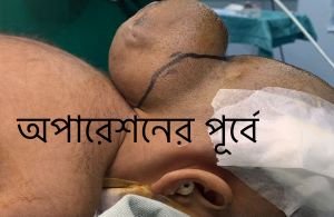 ওক্সিপিটাল এনকেফালোসিল (Occipital Encephalocele) রোগ কেন হয়?