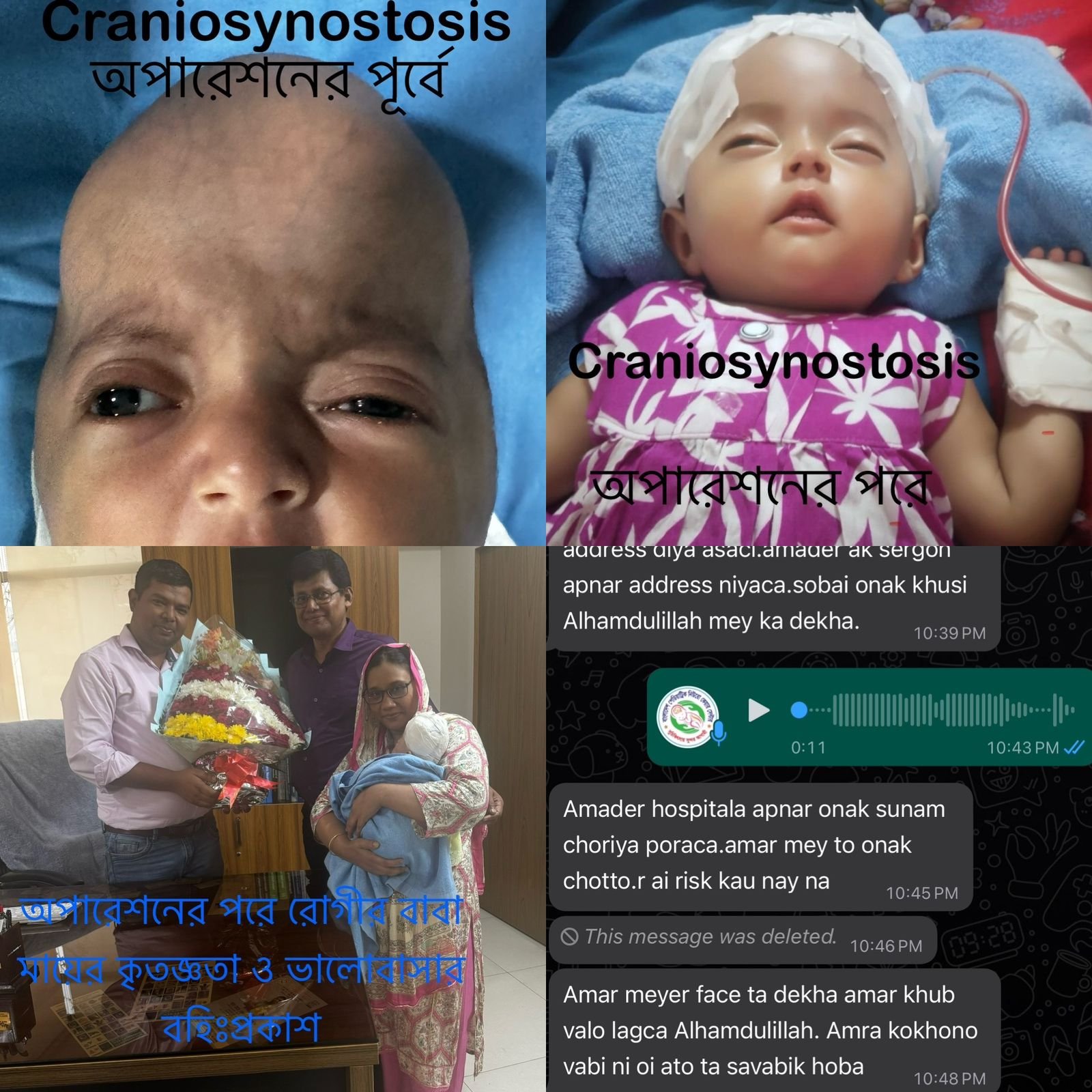 Craniosynostosis treatment in Bangladesh.