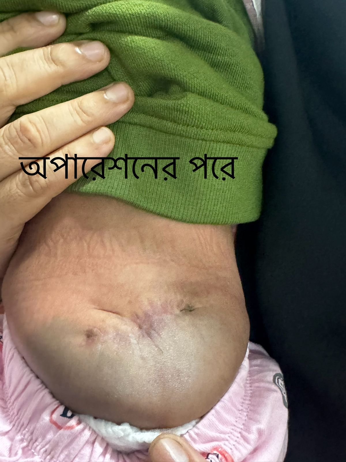 মায়েলোমেনিঙ্গোসিল (Myelomeningocele) রোগের অপারেশন কোথায় করাবেন?