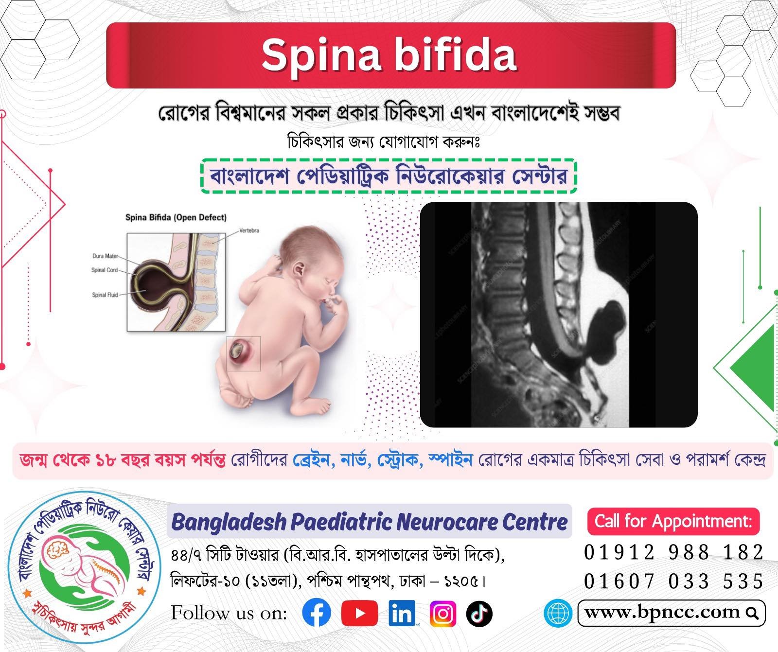 Spina Bifida Surgery Now Successfully Performed in Bangladesh